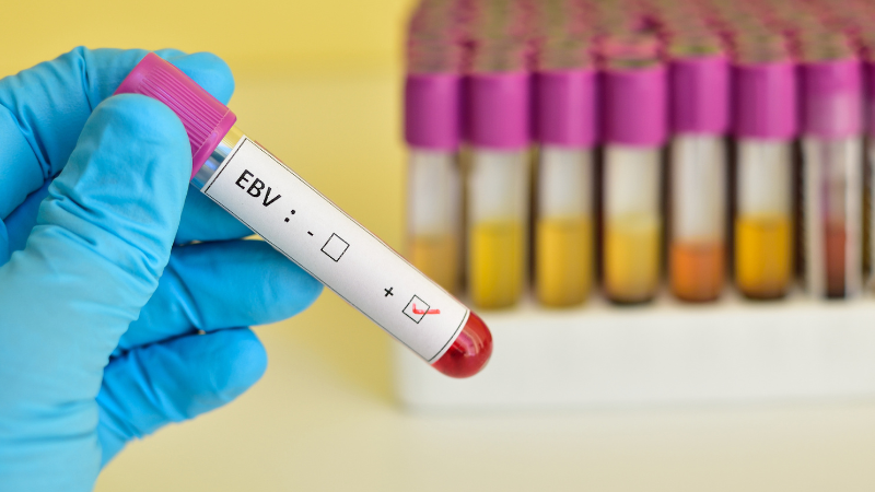 Positive Blutprobe nach Testung auf das Epstein Barr Virus (EBV)