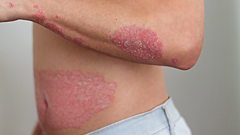 Risikofaktoren der Psoriasis umfassen vor allem Stress, sind zumeist allerdings genetisch bedingt.