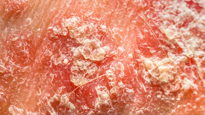 Hautveränderungen bei einer Person mit Psoriasis - typisches Erscheinungsbild der Schuppenflechte.