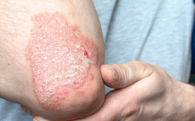 Psoriasis Schuppenflechte: Symptome, Ursachen und Therapien