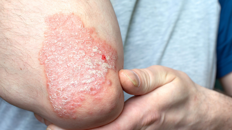 Psoriasis Schuppenflechte: Symptome, Ursachen und Therapien