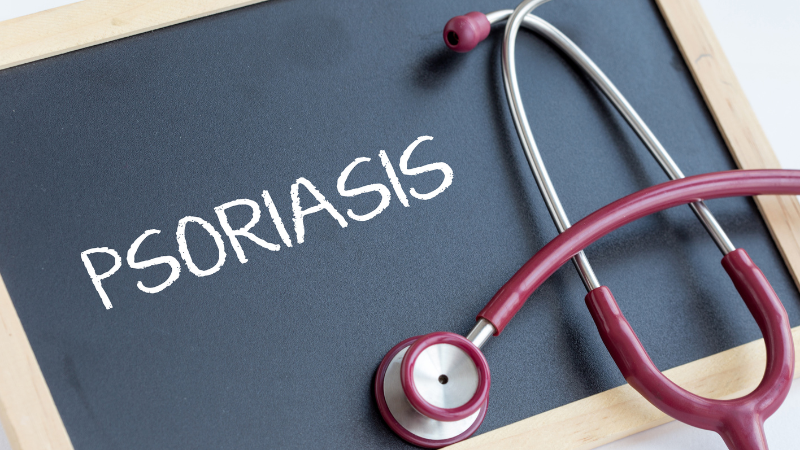 Es gibt verschiedene Arten von Psoriasis Schuppenflechte, leider gibt es aktuell nur die Möglichkeit, die Symptome zu lindern.