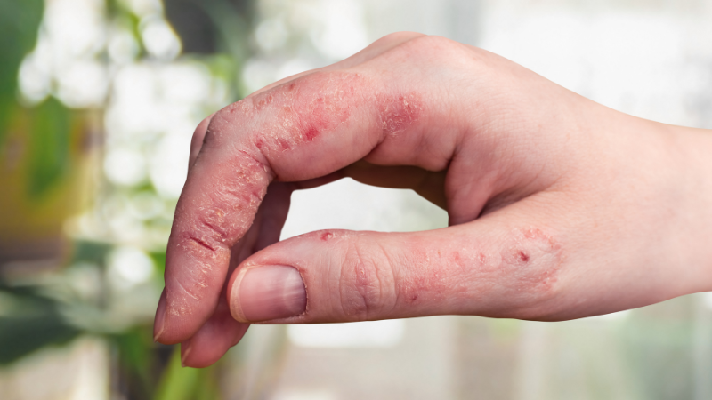 Psoriasis Schuppenflechte ist mit der richtigen Symptombehandlung gut in den Griff zu bekommen.