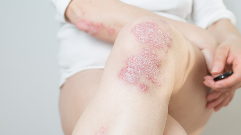 Psoriasis Schuppenflechte tritt oft an Gelenken, auf dem Kopf oder an den Nägeln auf.