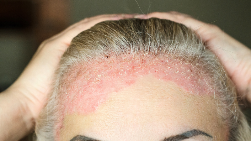 Psoriasis vulgaris Schuppenflechte am Kopf eines Betroffenen