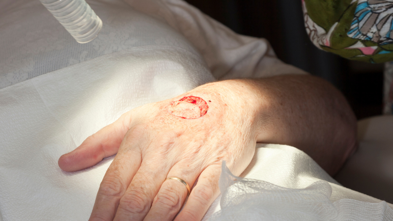 Ein Melanom wird aus dem Handrücken eines Patienten per Mohs-Operationsverfahren entfernt.