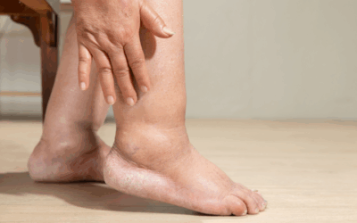 Was ist eine Gicht? Ursachen, Symptome und Behandlung