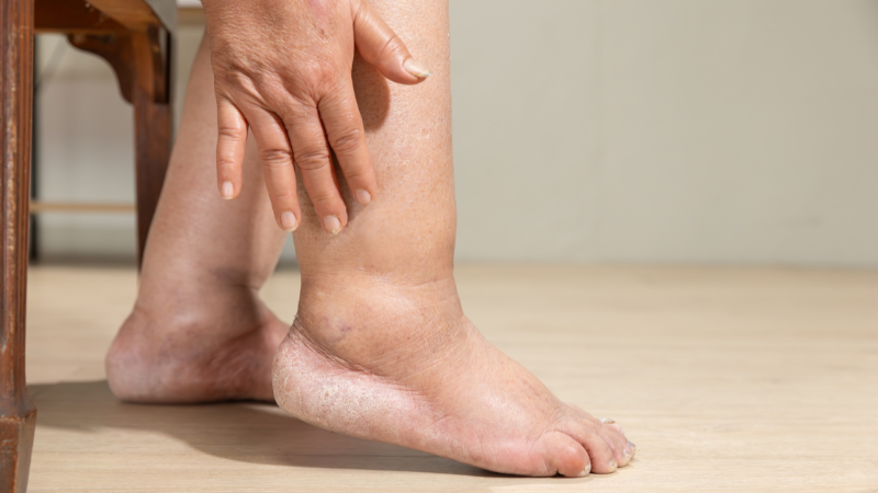 Geschwollene Füße sind ein Hauptmerkmal für einen starkn